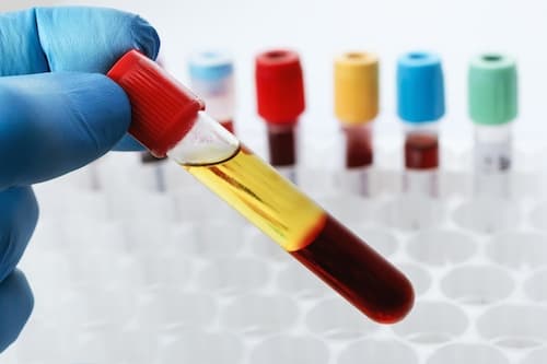 PRP Therapy