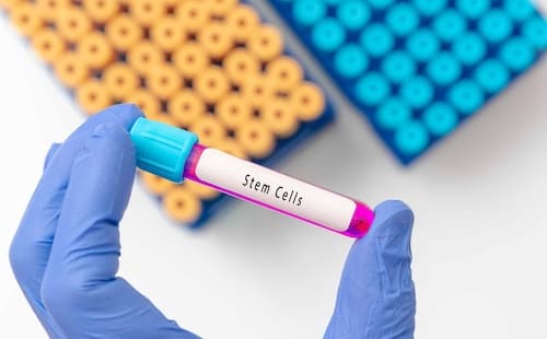 Stem Cell Therapy