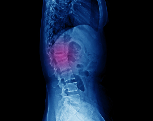 vertebral compression fractures, compression fractures, Osteoporotic Vertebral Compression fractures, Vertebral compression physical therapy center in Atlanta, Verispine Joint Centers vertebral compression fractures therapy center.