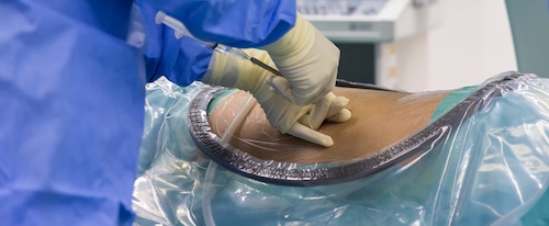 Epidural Steroid Injections for Spinal Stenosis Relief