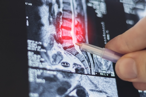 Verispine Joint Centers helping you get the car you need for a herniated disc. 