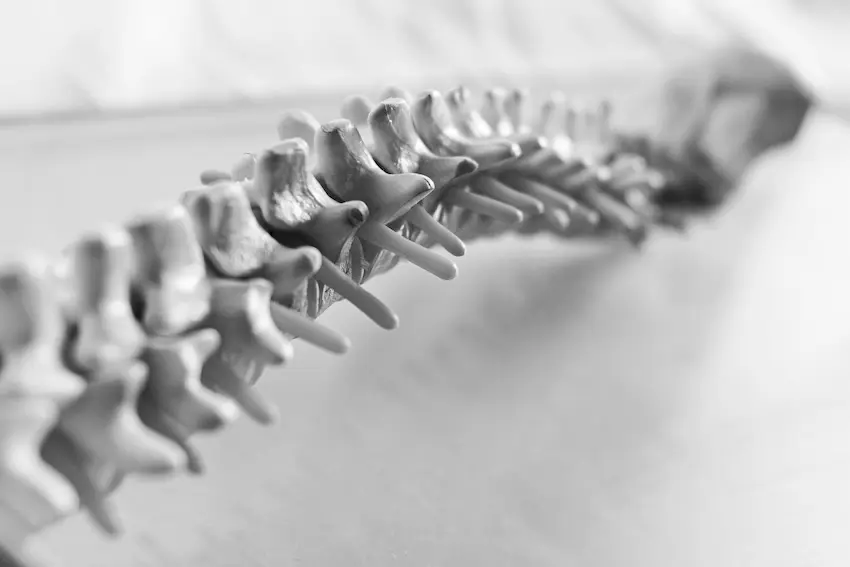 Spine anatomy showing herniated disc, spinal stenosis, and facet arthritis causing functional limitations
