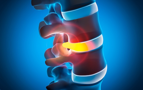 Degenerative Disc Disease Concept